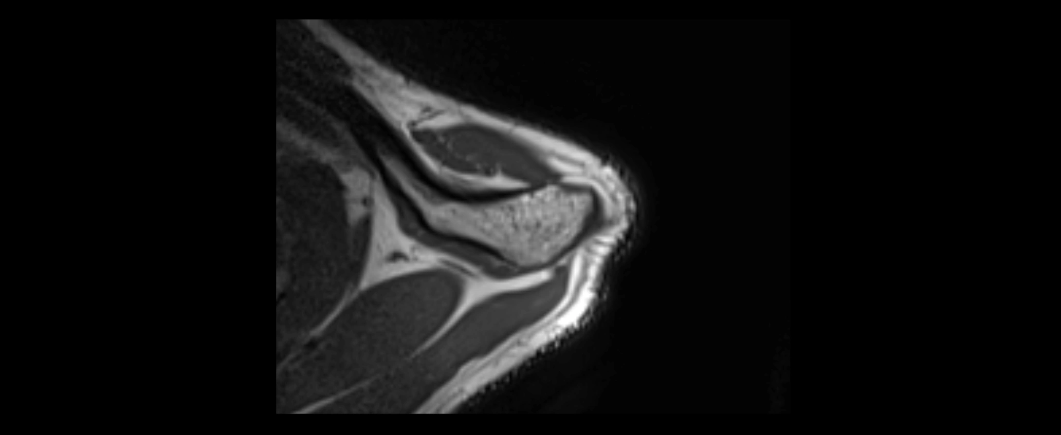shoulder ligaments axial 3d 3t mri image-img-00005-00017.webp